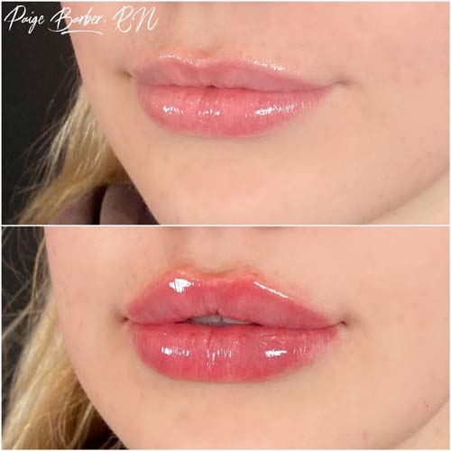 Lip Augmentation Before & After Photos by Flawless Medspa in Las Vegas NV