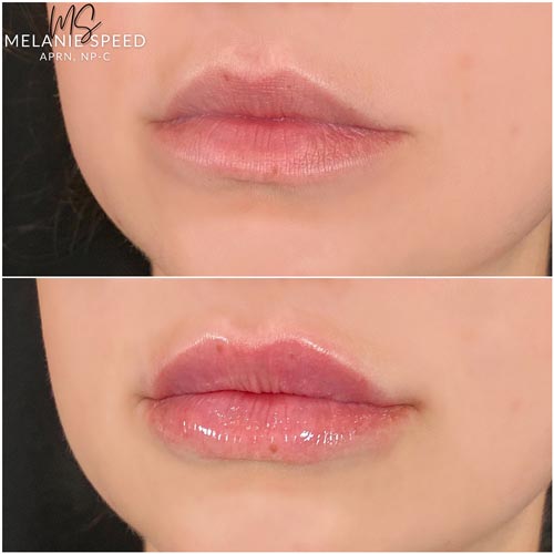 Lip Augmentation Before & After Photos by Flawless Medspa in Las Vegas NV