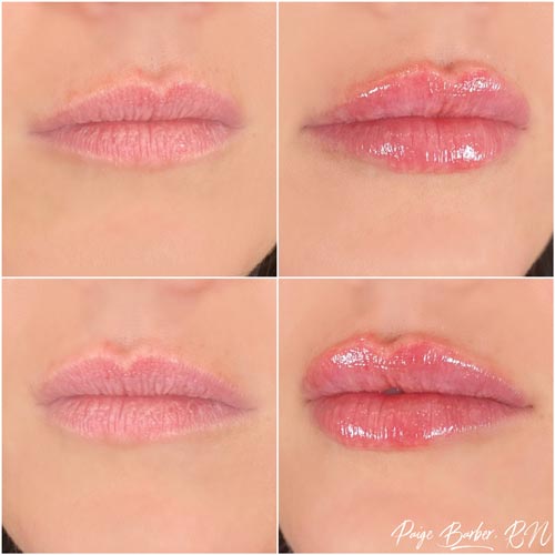 Lip Augmentation Before & After Photos by Flawless Medspa in Las Vegas NV