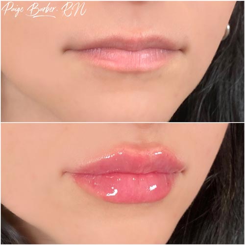 Lip Augmentation by Flawless Medspa