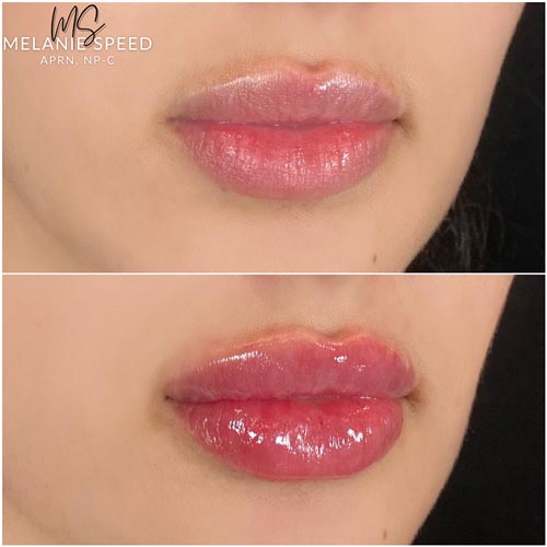 Lip Augmentation Before & After Photos by Flawless Medspa in Las Vegas NV