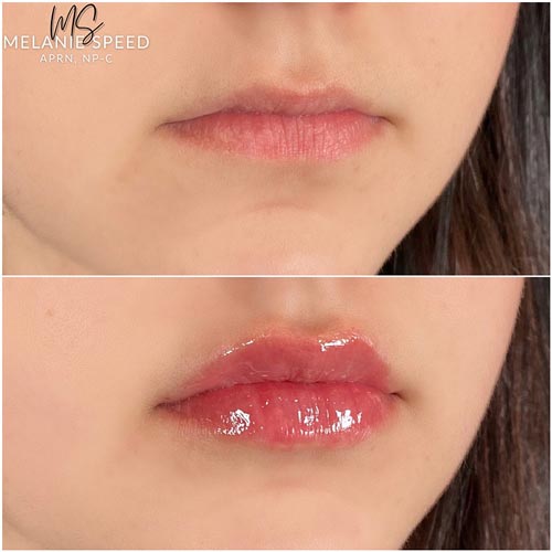 Lip Augmentation Before & After Photos by Flawless Medspa in Las Vegas NV