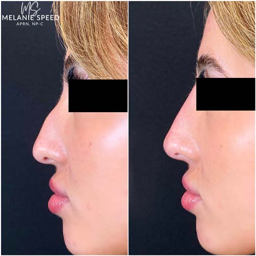 Nose Correction by Flawless Medspa