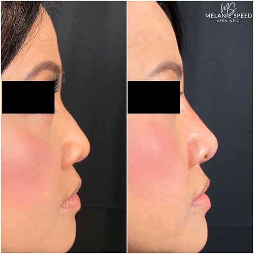 Nose Correction by Flawless Medspa