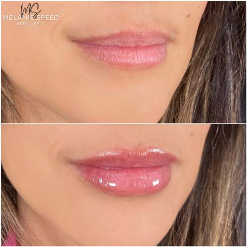 Lip Augmentation by Flawless Medspa