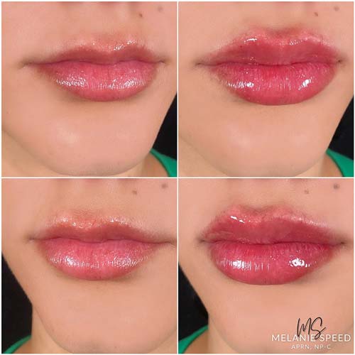 Lip Augmentation by Flawless Medspa