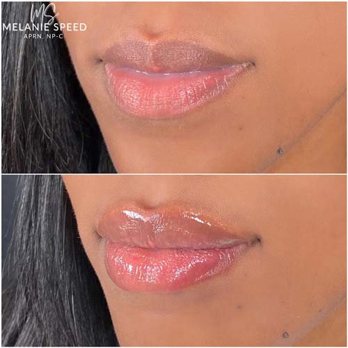 Lip Augmentation by Flawless Medspa