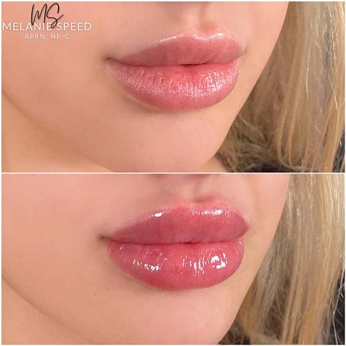 Lip Augmentation by Flawless Medspa