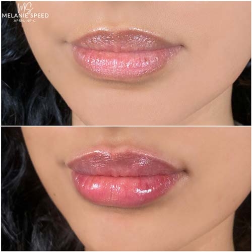 Lip Augmentation by Flawless Medspa