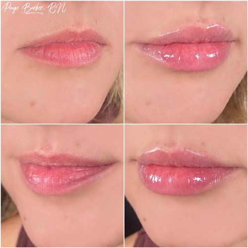 Lip Augmentation by Flawless Medspa