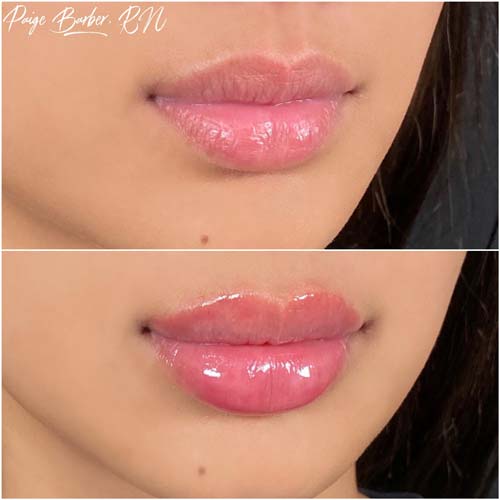 Lip Augmentation by Flawless Medspa