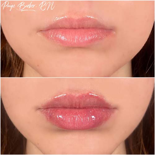 Lip Augmentation by Flawless Medspa