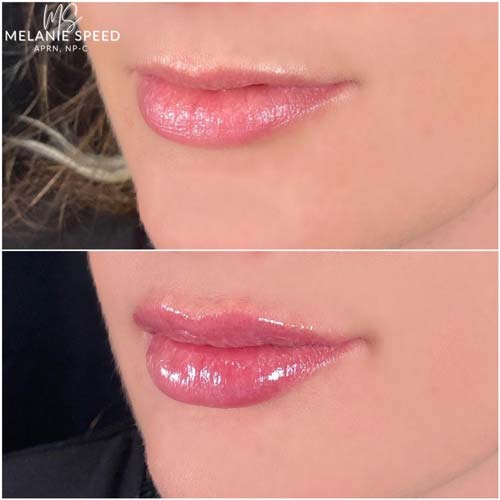 Lip Augmentation by Flawless Medspa