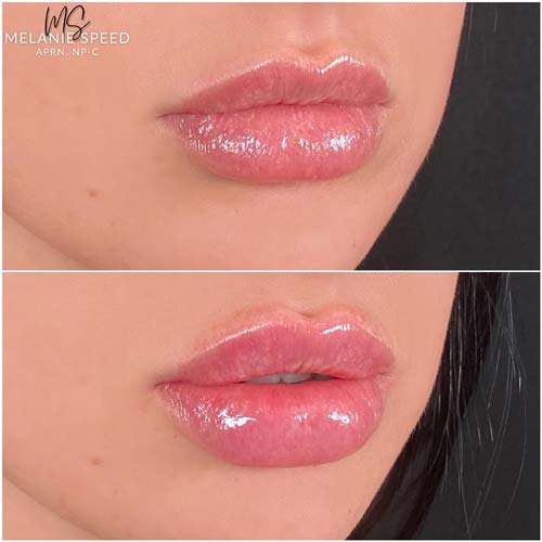 Lip Augmentation by Flawless Medspa