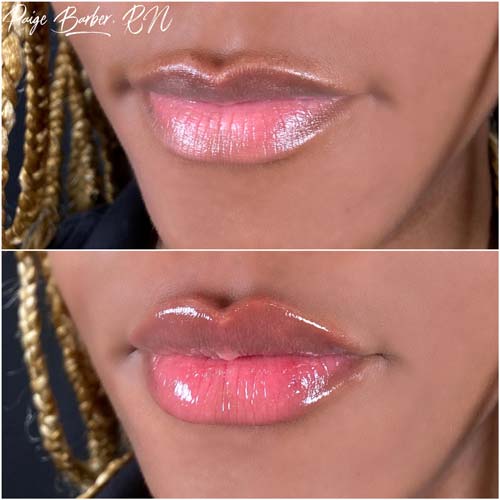 Lip Augmentation by Flawless Medspa