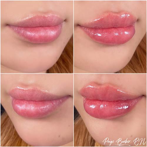 Lip Augmentation by Flawless Medspa