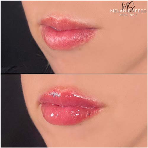 Lip Augmentation by Flawless Medspa