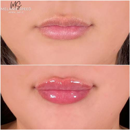 Lip Augmentation by Flawless Medspa