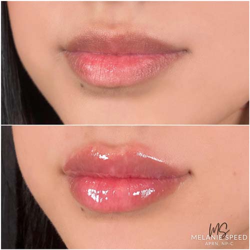 Lip Augmentation by Flawless Medspa