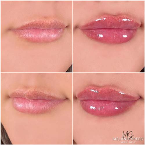 Lip Augmentation by Flawless Medspa