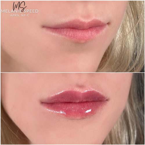 Lip Augmentation by Flawless Medspa