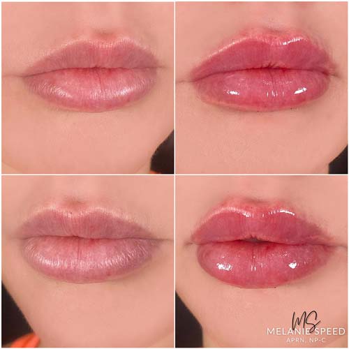 Lip Augmentation by Flawless Medspa