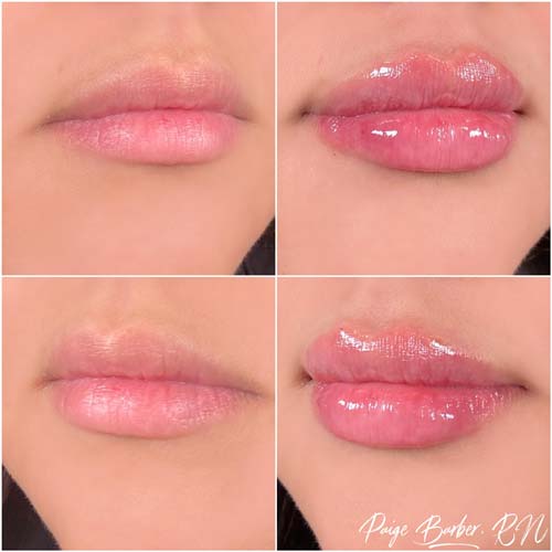 Lip Augmentation by Flawless Medspa