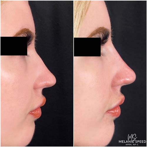 Nose Correction by Flawless Medspa