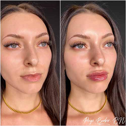 Lip Augmentation by Flawless Medspa Lip Augmentation by Flawless Medspa