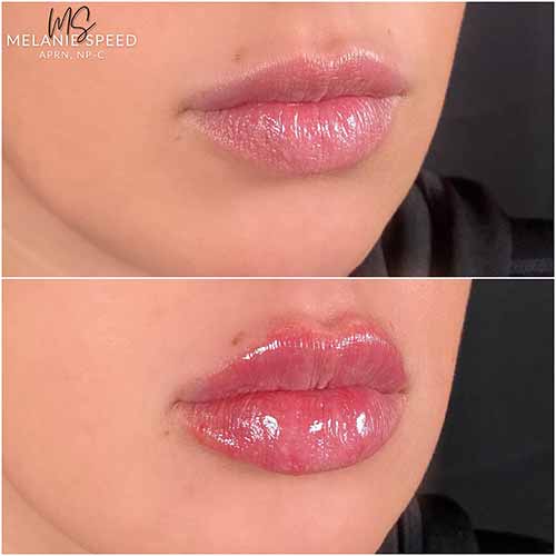 Lip Augmentation by Flawless Medspa