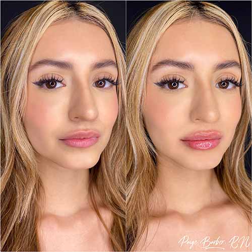 Lip Augmentation by Flawless Medspa Lip Augmentation by Flawless Medspa