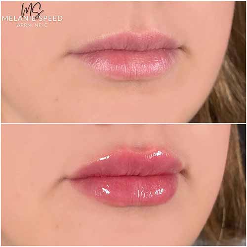 Lip Augmentation by Flawless Medspa