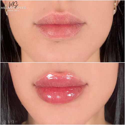 Lip Augmentation by Flawless Medspa