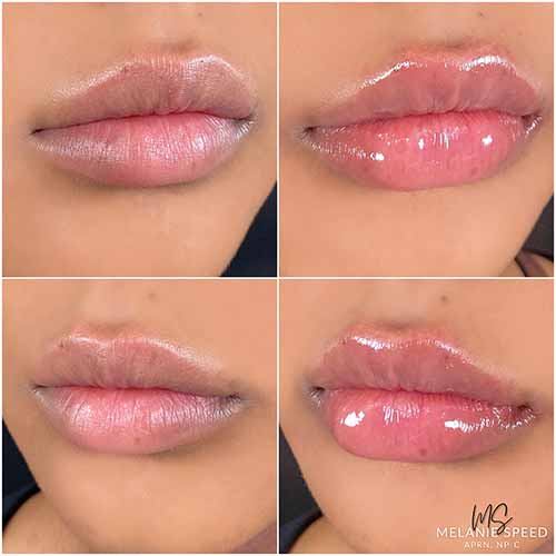 Lip Augmentation by Flawless Medspa