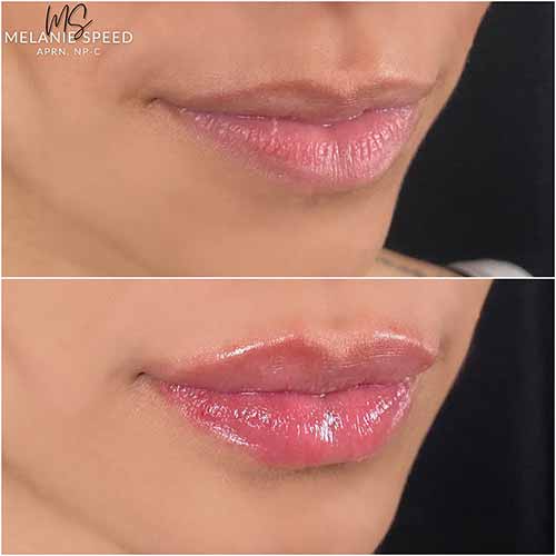 Lip Augmentation by Flawless Medspa