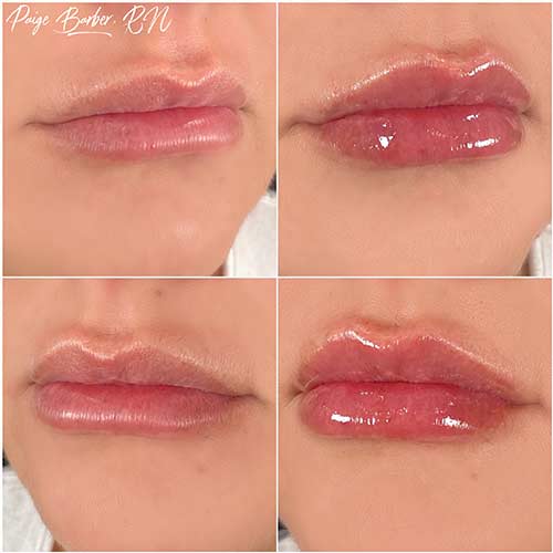 Lip Augmentation by Flawless Medspa