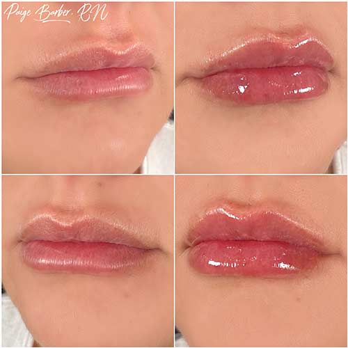 Lip Augmentation by Flawless Medspa Lip Augmentation by Flawless Medspa