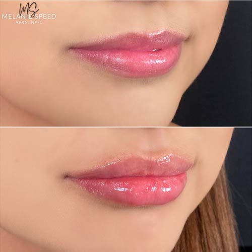 Lip Augmentation by Flawless Medspa