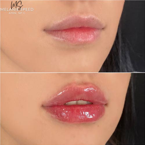 Lip Augmentation by Flawless Medspa