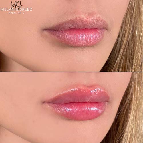 Lip Augmentation by Flawless Medspa