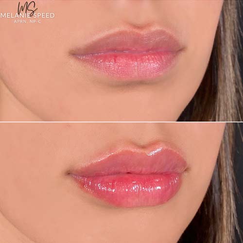 Lip Augmentation by Flawless Medspa