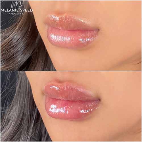 Lip Augmentation by Flawless Medspa