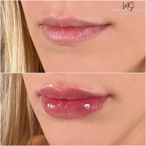 Lip Augmentation by Flawless Medspa