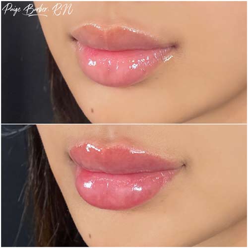 Lip Augmentation by Flawless Medspa