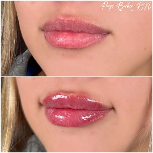 Lip Augmentation by Flawless Medspa