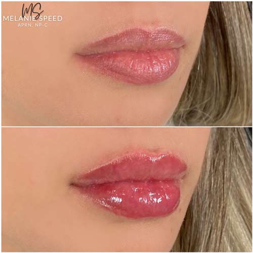 Lip Augmentation by Flawless Medspa