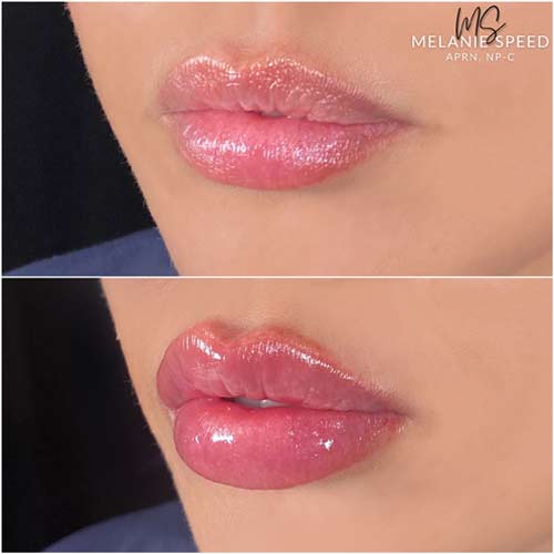 Lip Augmentation by Flawless Medspa