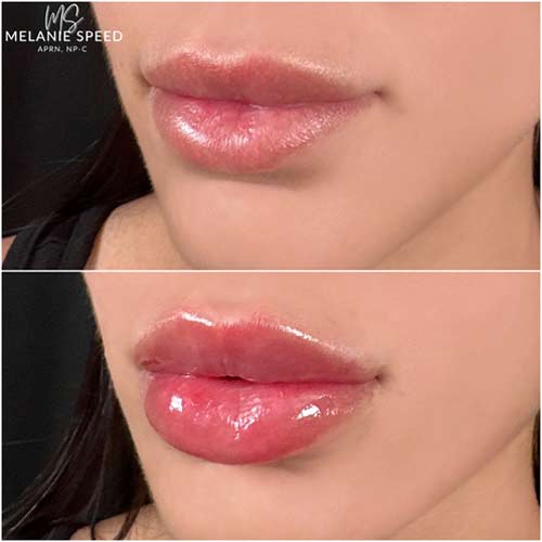 Lip Augmentation by Flawless Medspa