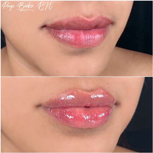 Lip Augmentation by Flawless Medspa