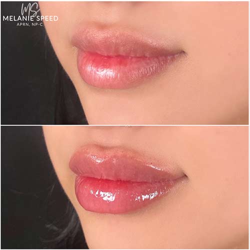 Lip Augmentation by Flawless Medspa